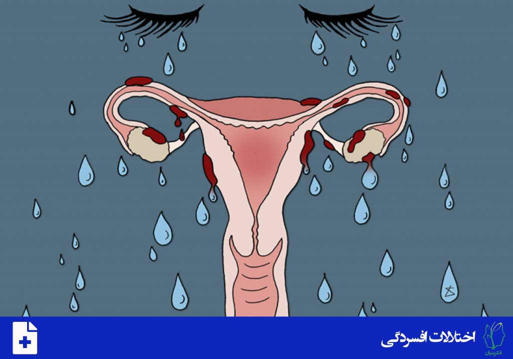 اختلال ملال پیش از قاعدگی