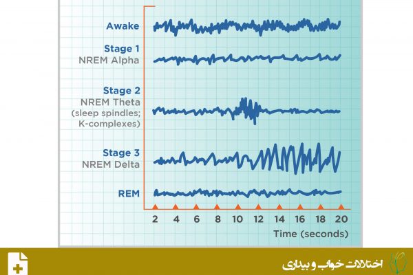 اختلالات برانگیختگی بدون حرکت سریع چشم