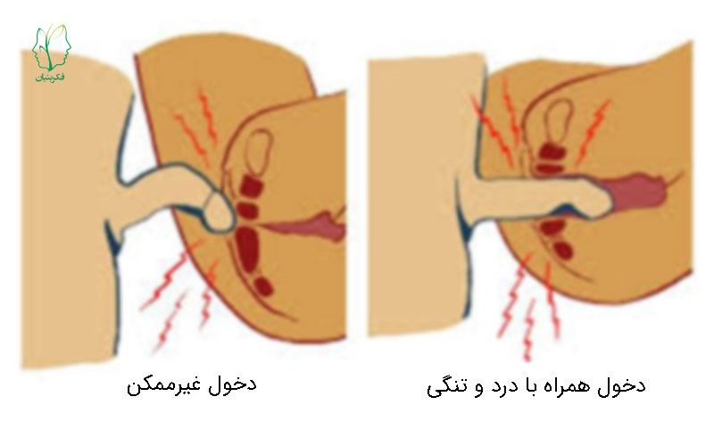 اختلال دخول / درد تناسلی – لگنی یا واژینیسموس