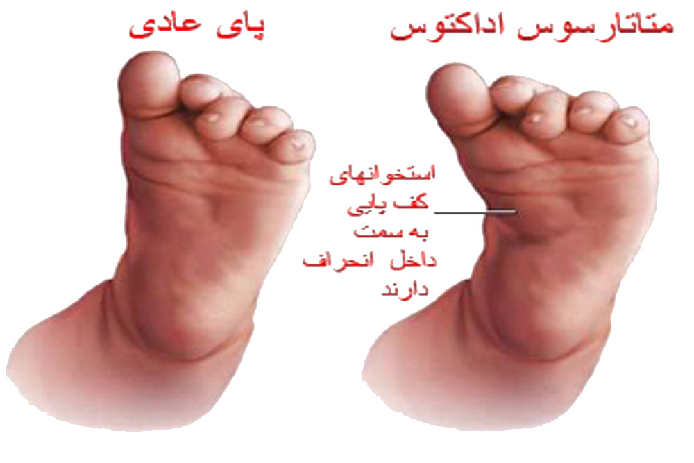 پای عادی و غیرعادی