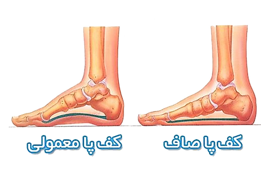 کف پا صاف و کف پا معمومی